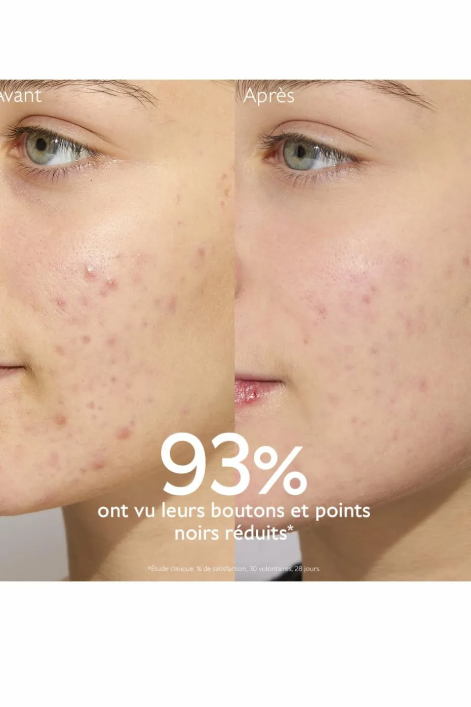 Kit anti-acné Vinopure