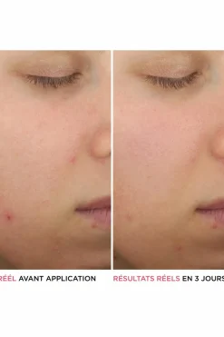 Sérum anti-acné à l’acide salicylique Bye Bye Serum